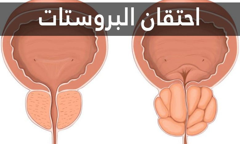 احتقان البروستات