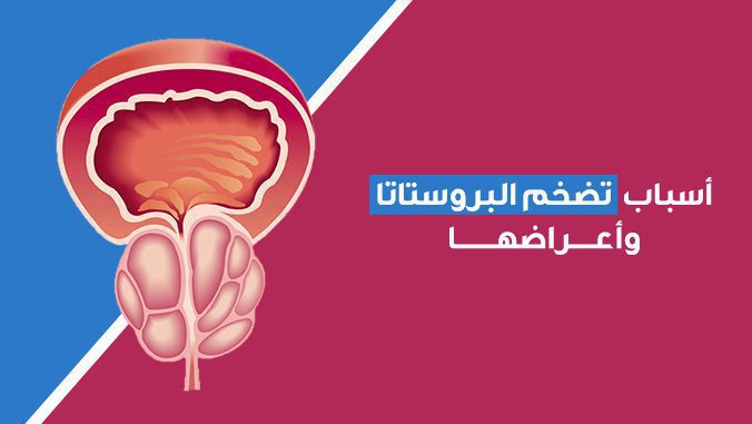 اسباب تضخم البروستات وعلاجها