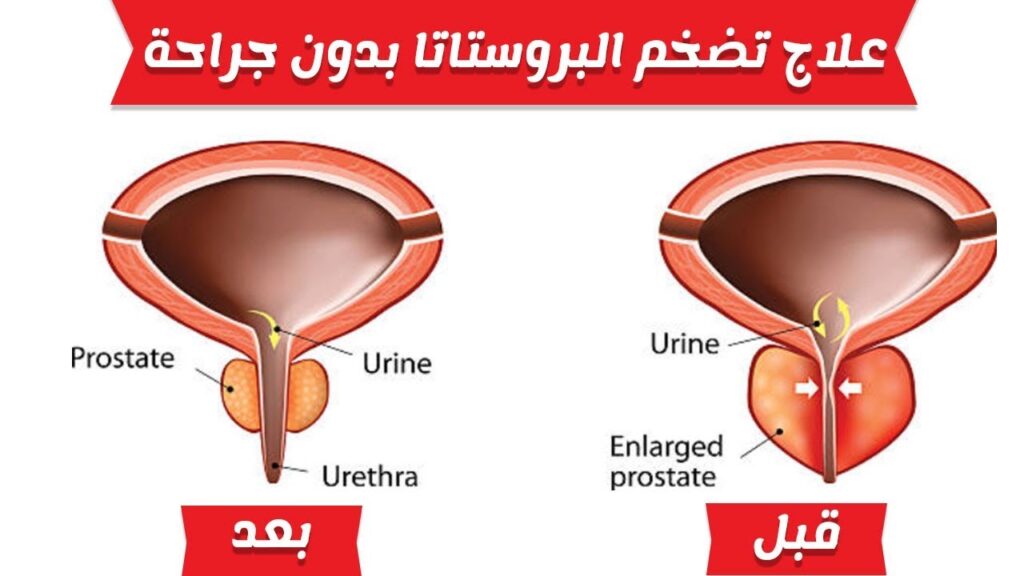 علاج البروستات بدون جراحة