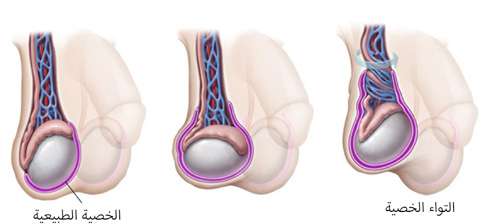 اعراض التواء الخصية