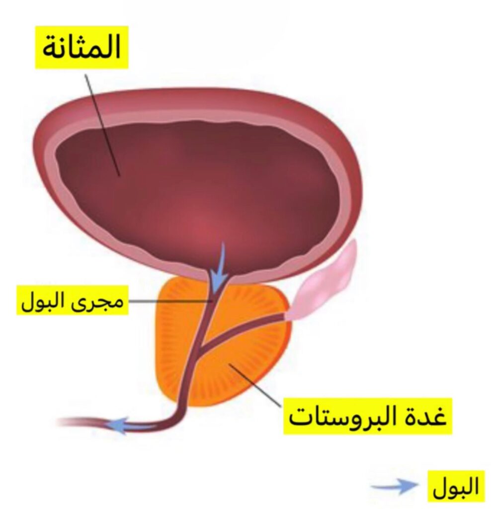 علاج تكلس البروستات